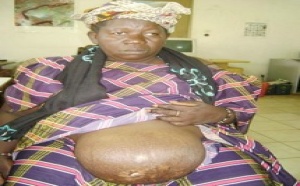 [Solidarité] SOS pour Awa Coulibaly : Elle souffre d’une hernie ombilicale et a besoin d’une intervention incessamment