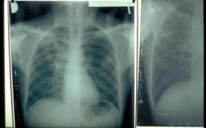 PROPAGATION DE LA TUBERCULOSE  L’ampleur devient inquiétante dans les banlieues