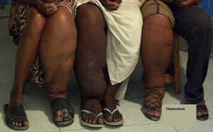 Côte d’Ivoire: 74 districts sanitaires touchés par la maladie de l'éléphantiasis!