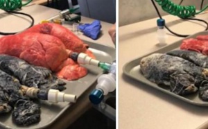 Choquant ! Une infirmière met en vidéo les poumons d’un fumeur décédé