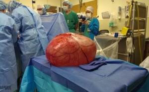 Insolite : Une tumeur ovarienne de 60 kilos retirée d'une femme