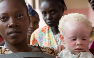 Afrique: «Les albinos sont considérés comme des êtres dotés de pouvoirs»