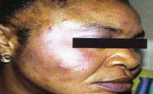 CAMEROUN : LES CAMEROUNAISES SE DÉCAPENT DE PLUS EN PLUS LA PEAU