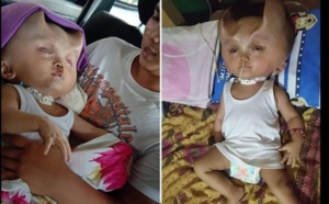 Insolite : Un bébé développe des « cornes » après une opération chirurgicale (Photos)