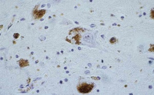 Japon: contre Parkinson, la greffe de cellules souches dans le cerveau?