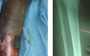 Touba: Mariama Thiongane fracture la jambe de sa voisine