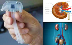 Adieu la machine de dialyse : les scientifiques ont créé un rein bionique !