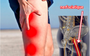 Comment soulager une sciatique naturellement