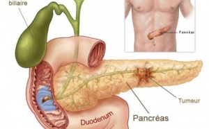 Cancer du pancréas : quels sont les facteurs de risque ?