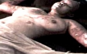 [VIDEO] L´affaire Oumy Guèye qui s´etait faite asperger d´acide par son ex-copain est en passe de virer au drame