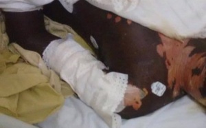 Nioro: une femme ébouillante sa co-épouse enceinte