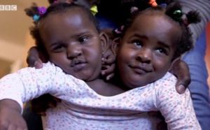 VIDEO - Ndèye et Marième, des jumelles siamoises qui luttent pour leur vie