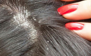 Saint-Louis: une fille meurt après avoir utilisé un produit contre les poux