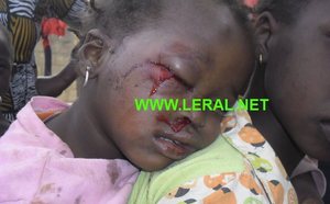 [Exclusivé Photo ] Les forces de l’ordre explosent l’œil d’une fillette de 2 ans