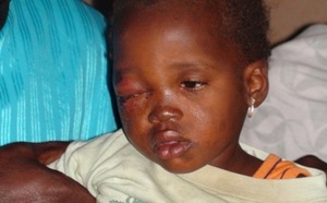 Victime d’une bombe lacrymogène de la police : Ndèye Dieynaba Fall n’a pas perdu son œil