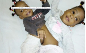 Cameroun : deux petites sœurs siamoises opérées avec succès en France