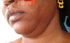 Photo:Sa coépouse lui arrache une partie de la joue avec ses dents