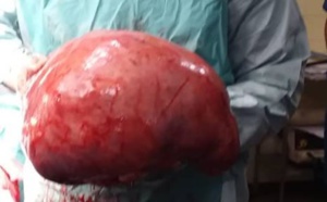 Photos: un fibrome de dix kilogrammes retiré d'une dame à Thiès