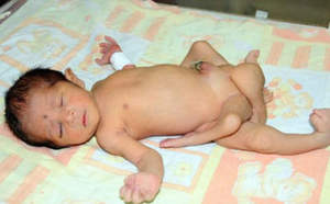 Un bébé né avec six jambes
