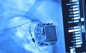 Un appareil implanté près du cœur pour prévenir l'infarctus