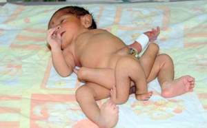 Le bébé né avec six jambes opéré avec succès
