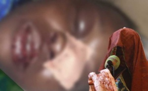 VIDEO - Défigurée par son mari, Gnima Mendy fait des révélations choquantes