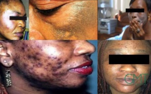 Dépigmentation: Au-delà d’une simple interdiction de la publicité