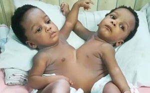 Des médecins nigérians séparent des siamoises