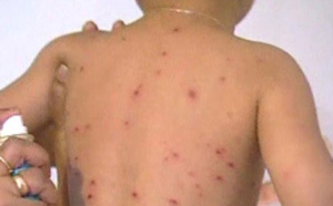Épidémie de rougeole à Vélingara : 26 cas déjà détectés