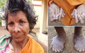 Inde: Découverte d’une femme avec 31 doigts et orteils 
