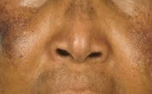 Dépigmentation : Des hommes sont entrés dans la danse