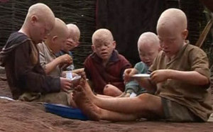 Plainte: Les Albinos veulent traduire en justice les criminels 