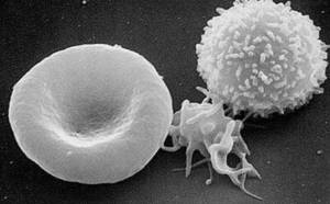 Une nouvelle maladie auto-immune aussi puissante que le VIH