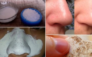Voici quelques façons naturelles pour se débarrasser définitivement des points noirs