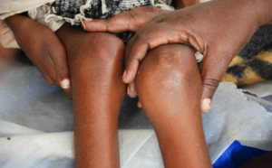 Matam : la Cellule de lutte contre la malnutrition veut renforcer ses réalisations et ses stratégies