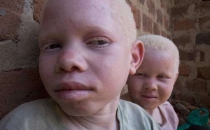 Quand les Albinos du Sénégal se fâchent
