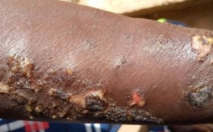 Maladie mystérieuse: Les femmes de Ndayane ont trouvé le "remède", en deux jours,...