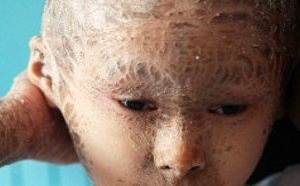 Un « enfant-poisson » couvert d’écailles de la tête aux pieds