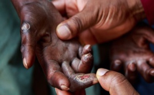 La lèpre au Sénégal: Près de 200 nouveaux cas recensés en 2020