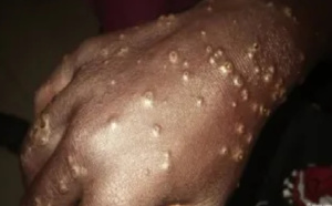 Maladie de la peau, un nouveau cas détecté à Thiaroye-sur-mer: Vers une deuxième vague ?