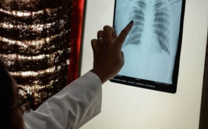Tuberculose: Diourbel est la deuxième région la plus touchée du Sénégal