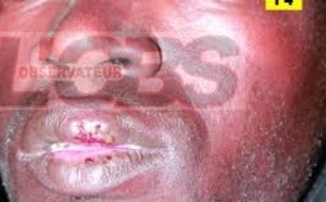 Première victime de la loi sur la baisse du loyer : Alpha Ndiaye se fait fendre les lèvres par son logeur