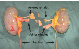 Santé : Plus de 25 millions FCfa pour se faire transplanter un rein