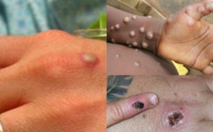 Ce qu’il faut savoir sur l’épidémie de variole du singe et ses différents modes de propagation