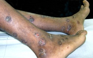 Castors pris de panique de la fièvre Ebola à cause d'un jeune garçon souffrant de dermatose sur le corps