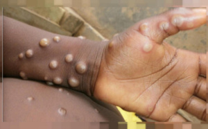 La Guinée, le Ghana et le Nigéria touchés : La variole du singe à nos portes