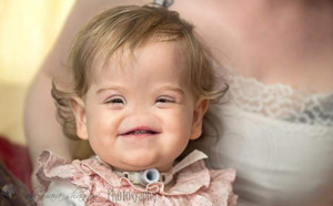 Une petite fille née sans nez