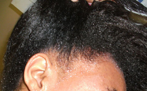 Alopécie ou chute de cheveux : traitements naturels