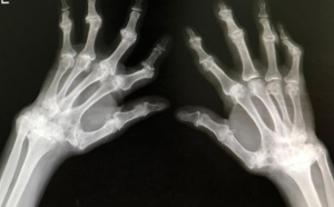 Polyarthrite rhumatoïde: Une maladie coûteuse qui s’attaque aux articulations, aux muscles…