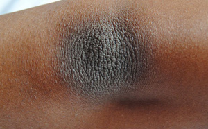 Comment réduire les taches sombres naturellement sur les coudes et les genoux